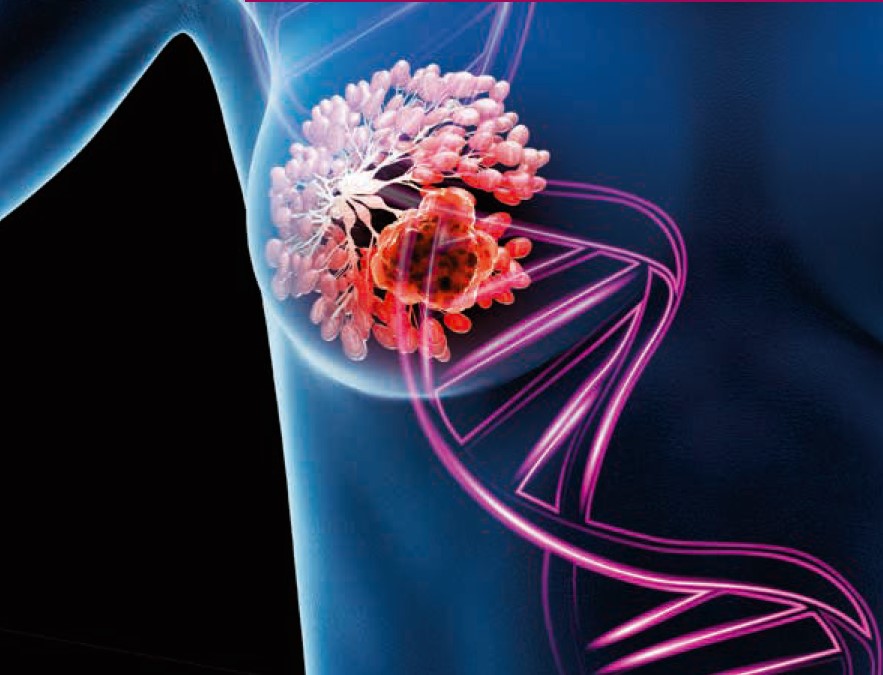 Molekulargenetische Diagnostik beim Mammakarzinom – klinischer Nutzen der Liquid Biopsy